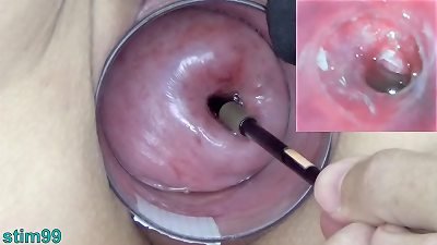 old cougar Cervix have fun with Endoscope asian webcam into Uterus
